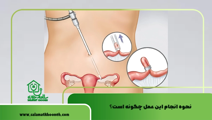 نحوه انجام این عمل چگونه است؟