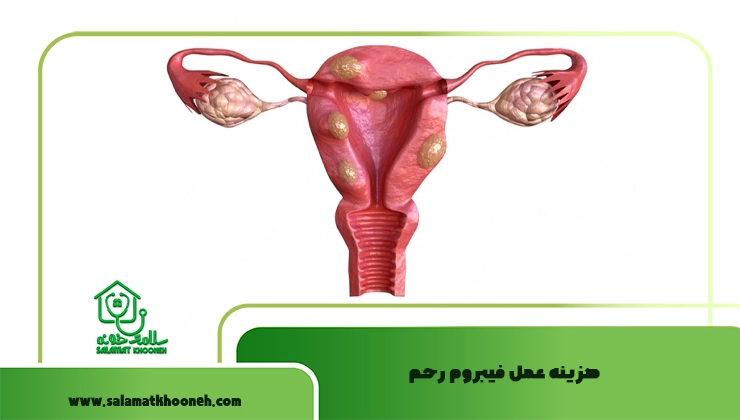 هزینه عمل فیبروم رحم