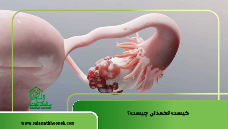 کیست تخمدان چیست؟