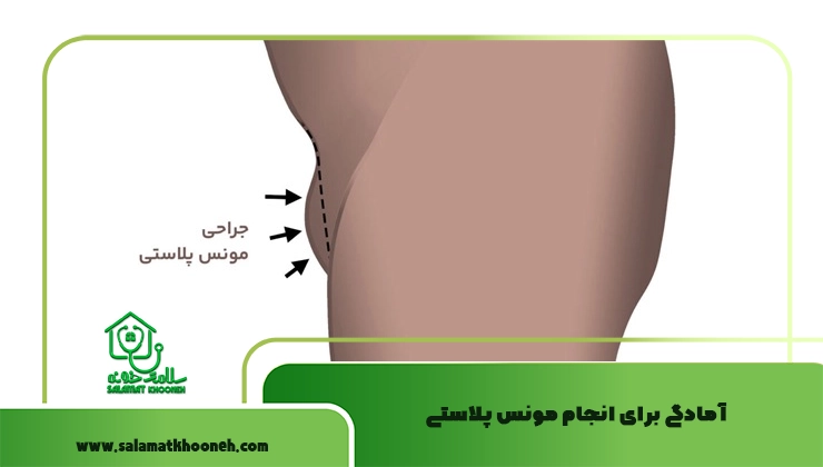 آمادگی برای انجام مونس پلاستی