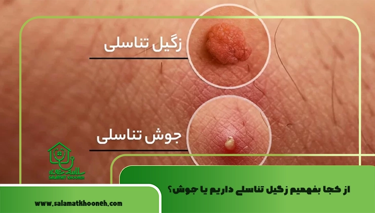 از کجا بفهمیم زگیل تناسلی داریم یا جوش؟