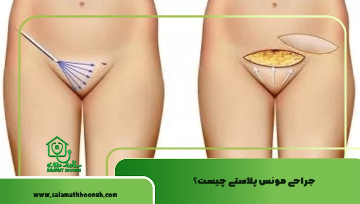 مونس پلاستی