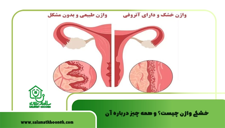 خشکی واژن
