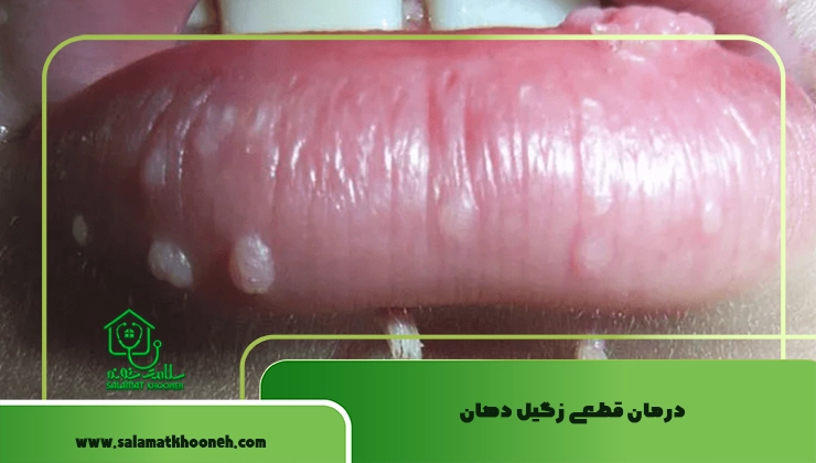 درمان قطعی زگیل دهان