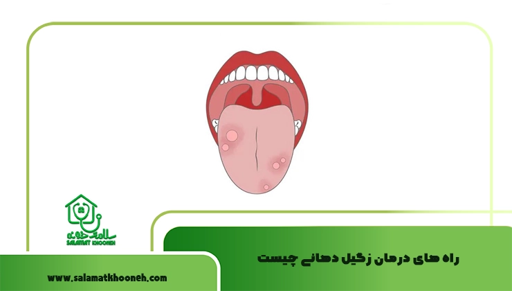  راه‌ های درمان زگیل دهانی چیست
