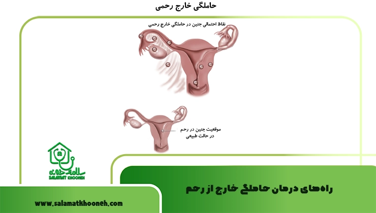 راه‌های درمان حاملگی خارج از رحم