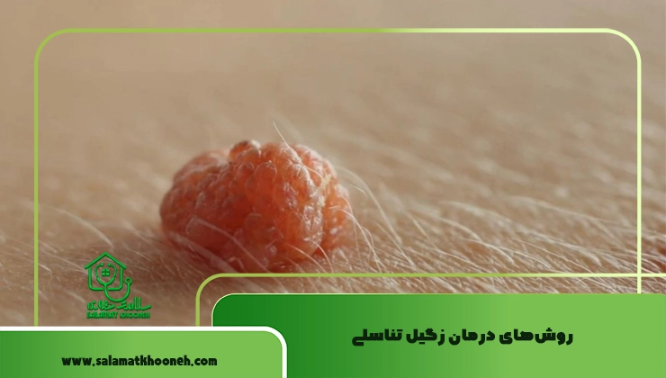 روش‌های درمان زگیل تناسلی