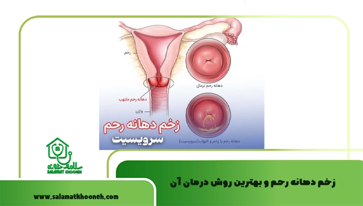 زخم دهانه رحم