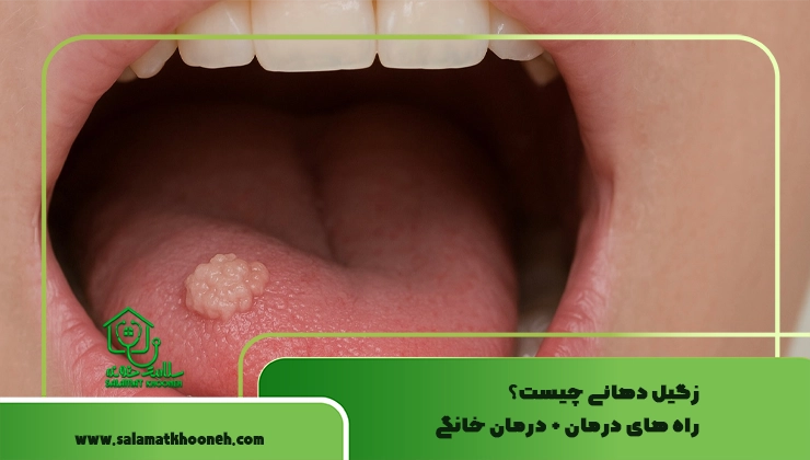 زگیل دهانی چیست