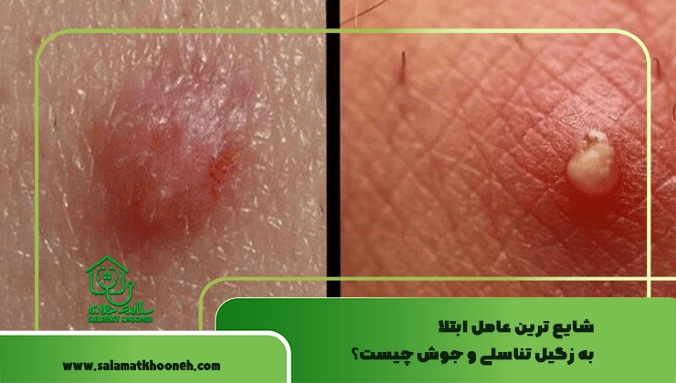 شایع‌ ترین عامل ابتلا به زگیل تناسلی و جوش چیست؟