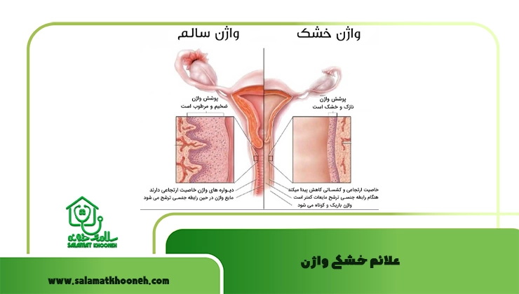 علائم خشکی واژن