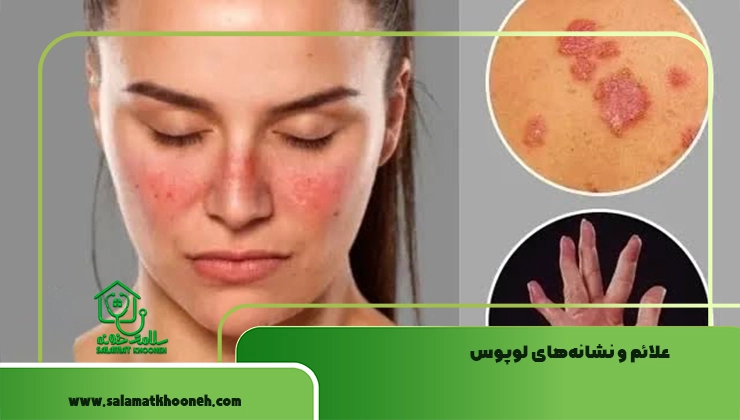 علائم لوپوس