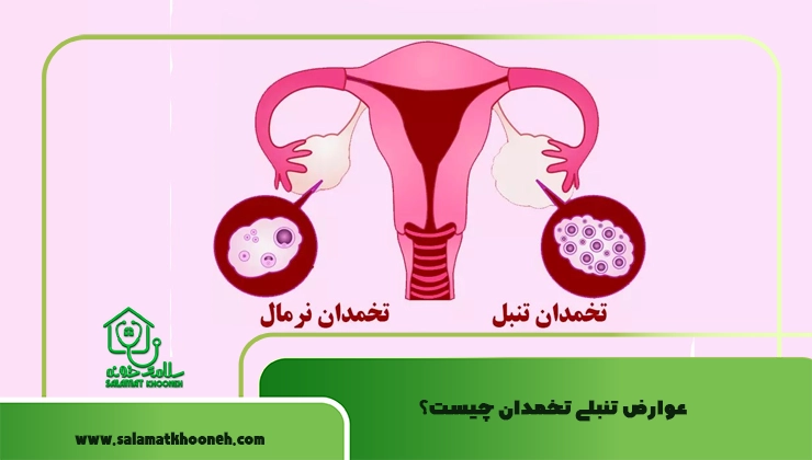عوارض تنبلی تخمدان