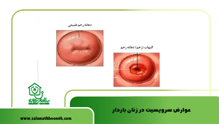 عوارض سرویسیت