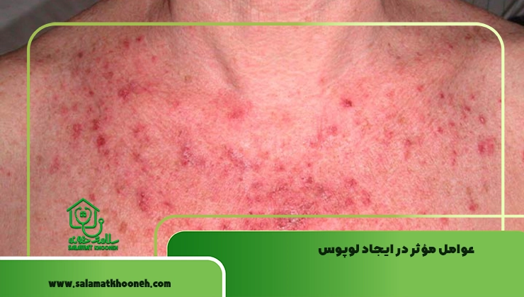 عوامل مؤثر در ایجاد لوپوس