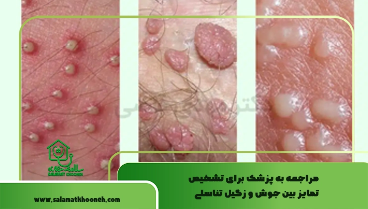 مراجعه به پزشک برای تشخیص تمایز بین جوش و زگیل تناسلی