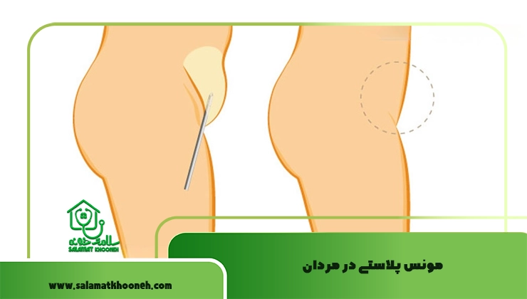 مونس پلاستی در مردان
