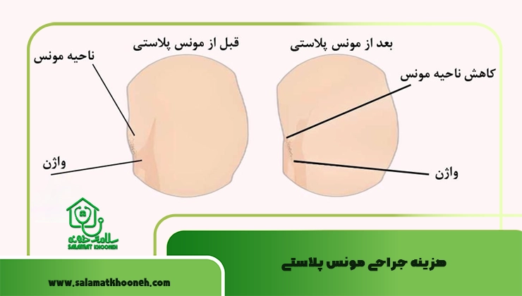  هزینه‌ جراحی مونس پلاستی