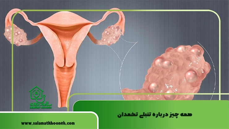 تنبلی تخمدان