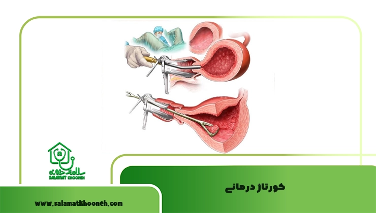 کورتاژ درمانی