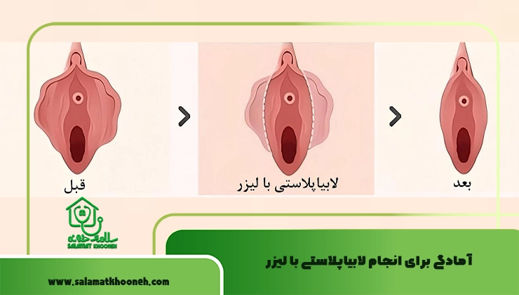 آمادگی برای انجام لابیاپلاستی با لیزر