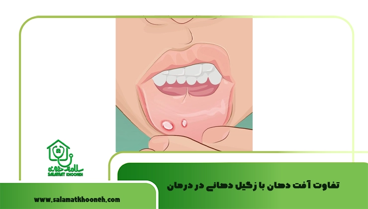 تفاوت آفت دهان با زگیل دهانی در درمان