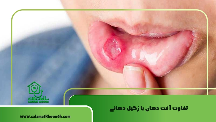 تفاوت آفت دهان با زگیل دهانی