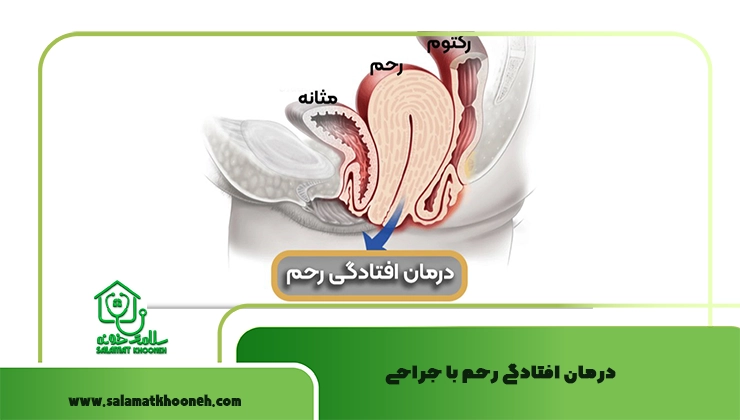 درمان افتادگی رحم
