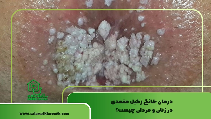 درمان خانگی زگیل مقعدی