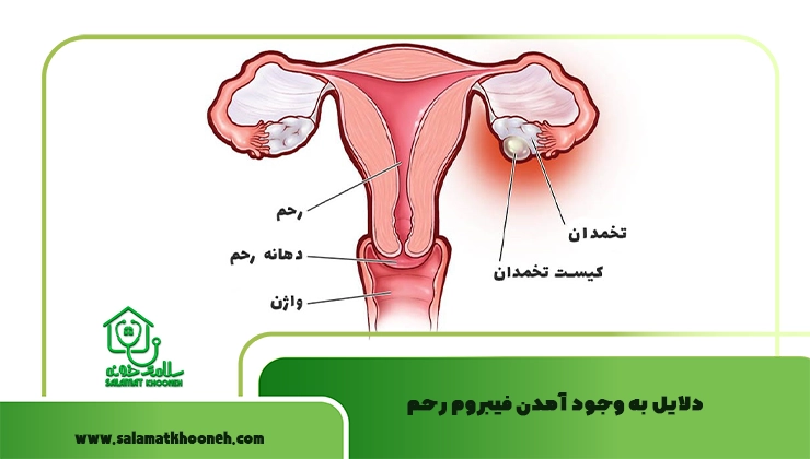 دلایل به وجود آمدن فیبروم رحم