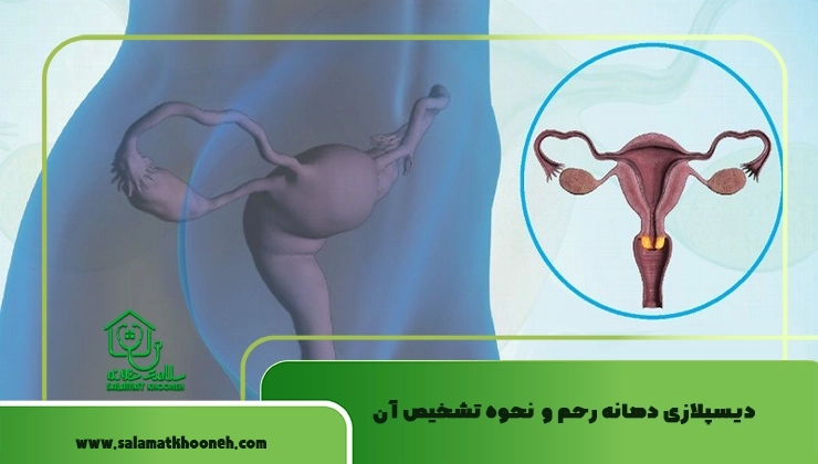 دیسپلازی دهانه رحم