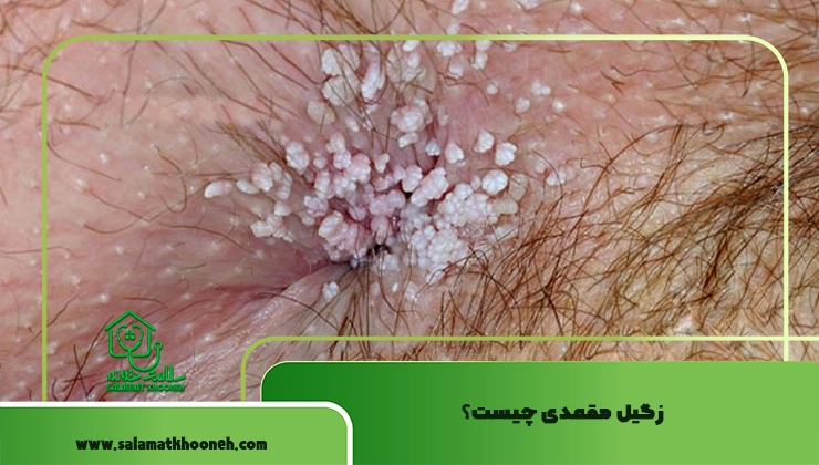 زگیل مقعدی