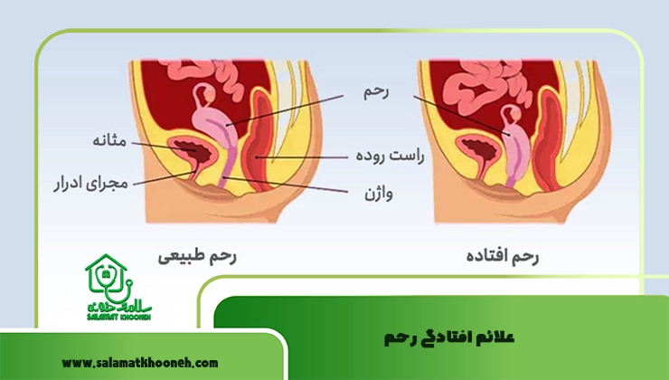 علائم افتادگی رحم