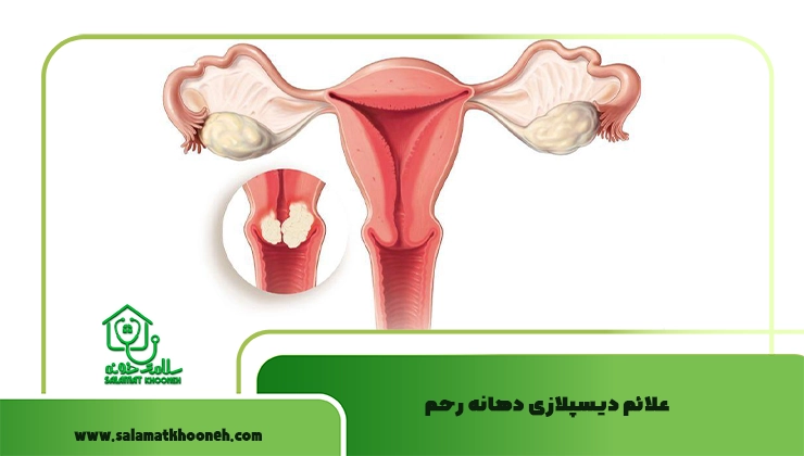 علائم دیسپلازی دهانه رحم