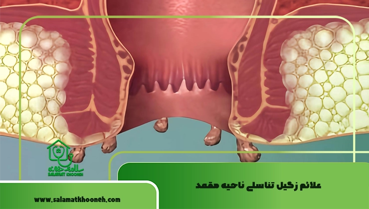 علائم زگیل تناسلی ناحیه مقعد