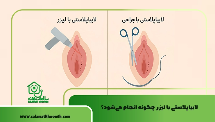 لابیاپلاستی و لیزر 
