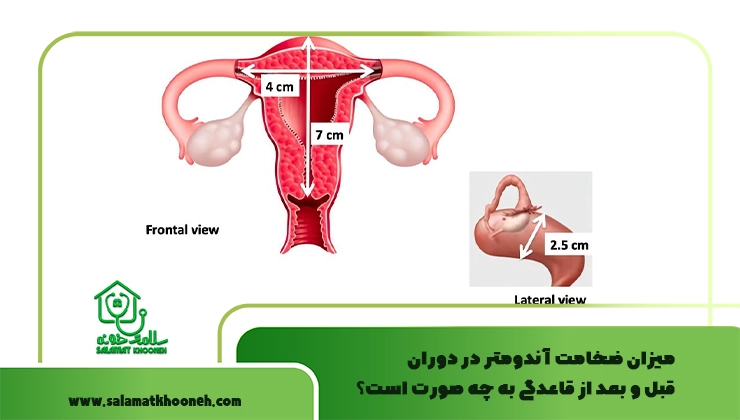 میزان ضخامت آندومتر