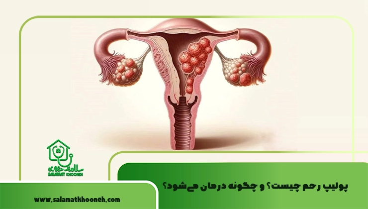پولیپ رحم