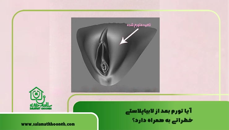 ورم کردن لابیا