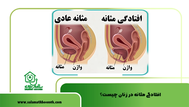 افتادگی مثانه چیست