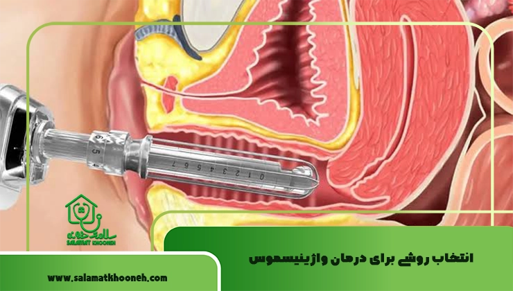 انتخاب روشی برای درمان واژینیسموس