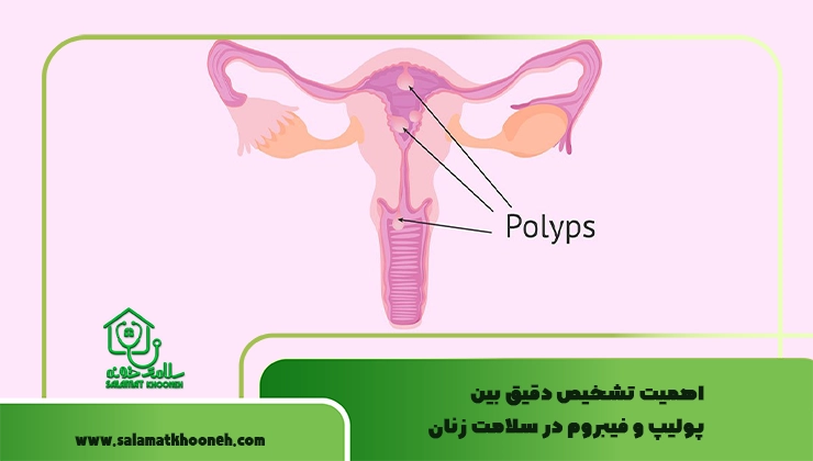 تشخیص بین پولیپ و فیبروم