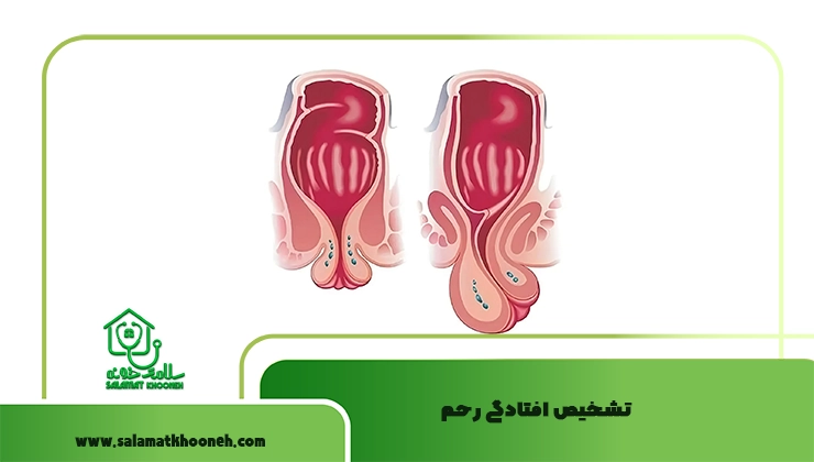 تشخیص افتادگی رحم