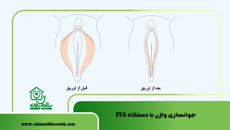 جوانسازی واژن با دستگاه EVA