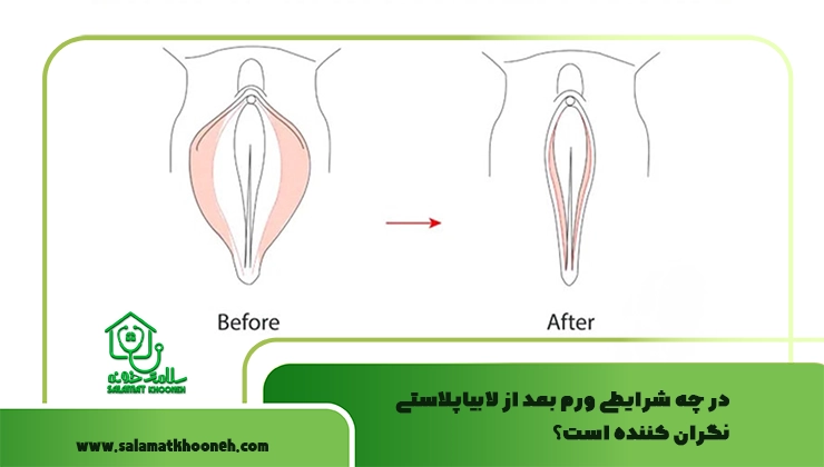 در چه شرایطی ورم بعد از لابیاپلاستی نگران کننده است؟