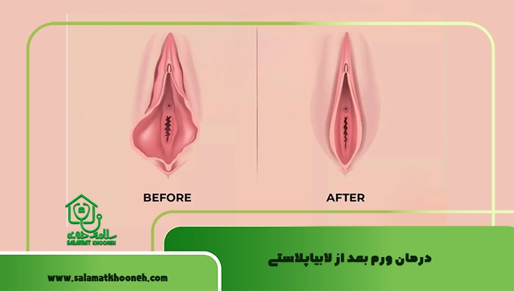 درمان ورم بعد از لابیاپلاستی