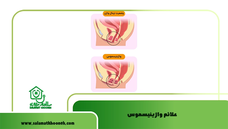 علائم واژینیسموس