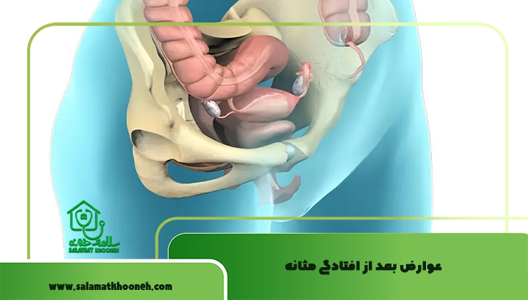 عوارض افتادگی مثانه
