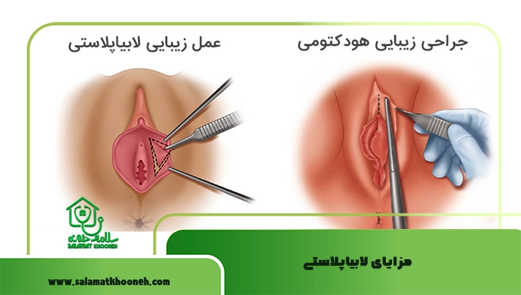 مزایای لابیاپلاستی
