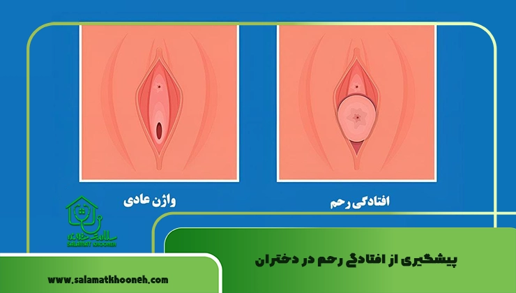 پیشگیری از افتادگی رحم در دختران